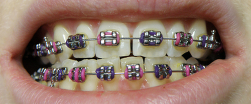 Orthobraces---dental-braces-lower-upper-jaw