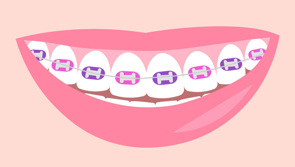 Best Colors For Braces | This 100% Reliable Quiz Tells You