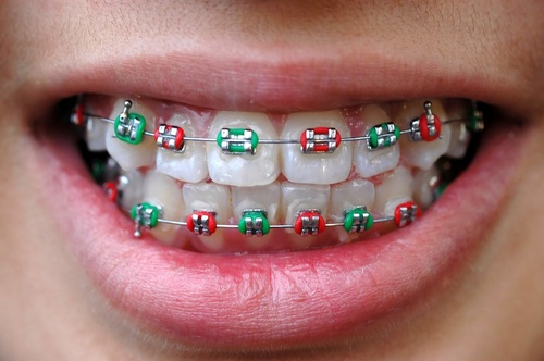 colored-braces